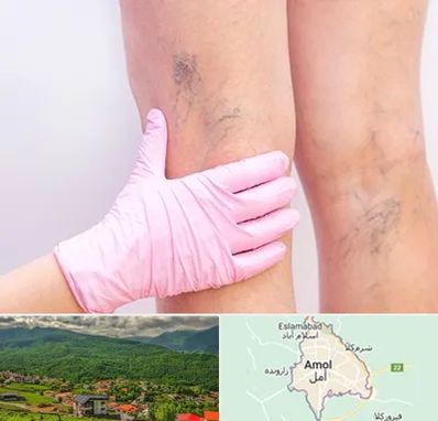 دکتر فوق تخصص واریس در آمل