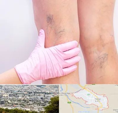 دکتر فوق تخصص واریس در یاسوج