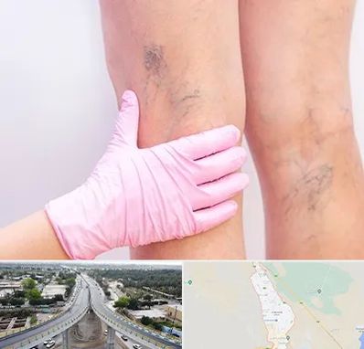 دکتر فوق تخصص واریس در اندیمشک