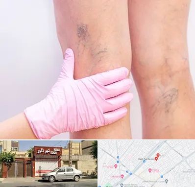 دکتر فوق تخصص واریس در باجک قم