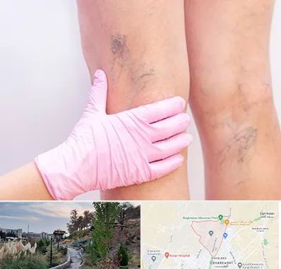 دکتر فوق تخصص واریس در باغستان کرج 