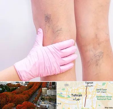 دکتر فوق تخصص واریس در ولیعصر 