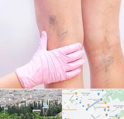 دکتر فوق تخصص واریس در محلاتی شیراز 