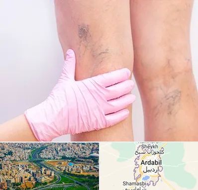 دکتر فوق تخصص واریس در اردبیل