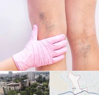 دکتر فوق تخصص واریس در اوین