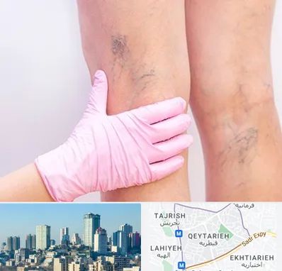 دکتر فوق تخصص واریس در قیطریه 