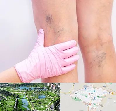 دکتر فوق تخصص واریس در بجنورد