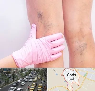 دکتر فوق تخصص واریس در شهر قدس