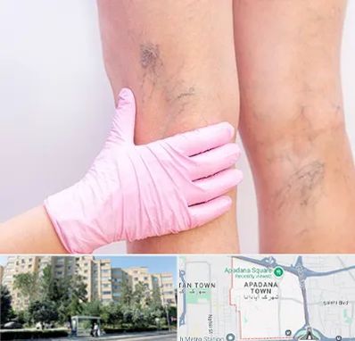 دکتر فوق تخصص واریس در آپادانا