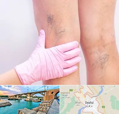 دکتر فوق تخصص واریس در دزفول