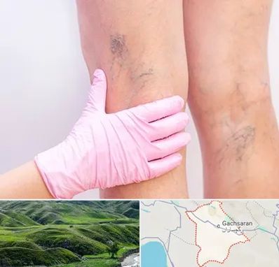 دکتر فوق تخصص واریس در گچساران