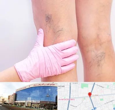 دکتر فوق تخصص واریس در نصف راه تبریز