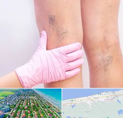 دکتر فوق تخصص واریس در فریدونکنار