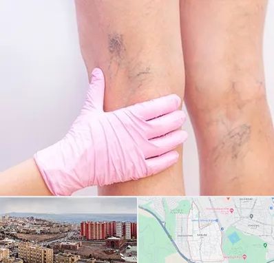 دکتر فوق تخصص واریس در سهند تبریز