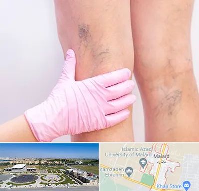 دکتر فوق تخصص واریس در ملارد