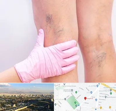 دکتر فوق تخصص واریس در هنگام 