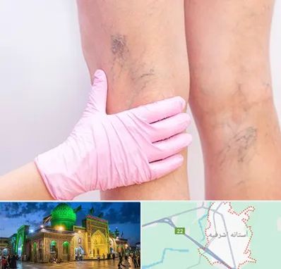 دکتر فوق تخصص واریس در آستانه اشرفیه