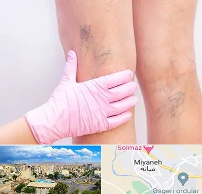 دکتر فوق تخصص واریس در میانه