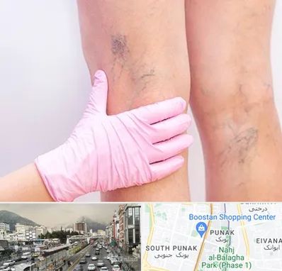 دکتر فوق تخصص واریس در پونک 