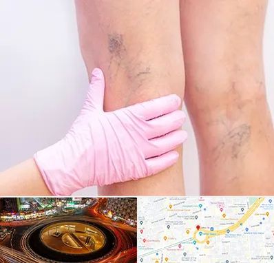 دکتر فوق تخصص واریس در میدان ولیعصر 