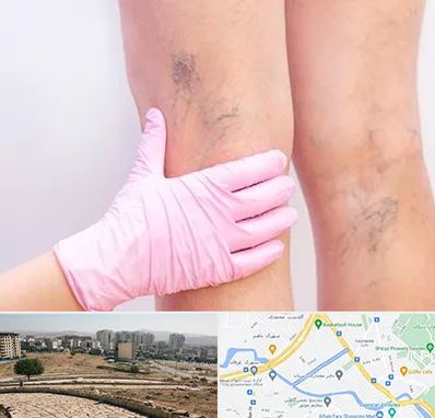 دکتر فوق تخصص واریس در کوی وحدت شیراز 