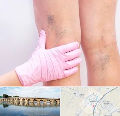 دکتر فوق تخصص واریس در فلاورجان