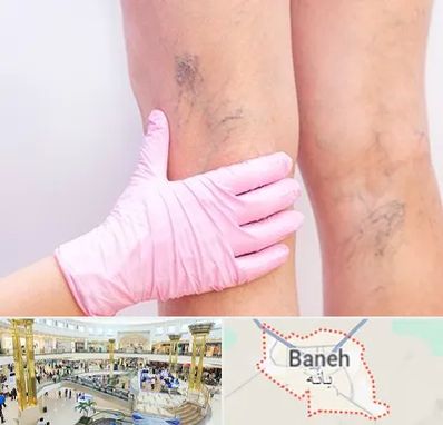 دکتر فوق تخصص واریس در بانه