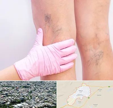 دکتر فوق تخصص واریس در شاهرود