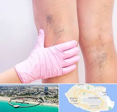 دکتر فوق تخصص واریس در کیش