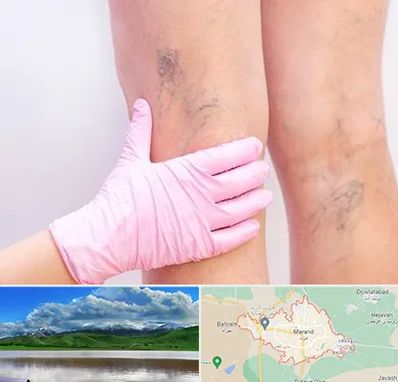 دکتر فوق تخصص واریس در مرند