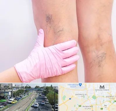 دکتر فوق تخصص واریس در جنوب تهران 