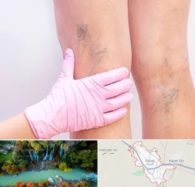 دکتر فوق تخصص واریس در دورود