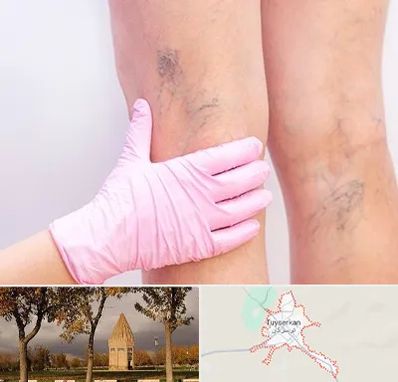 دکتر فوق تخصص واریس در تویسرکان