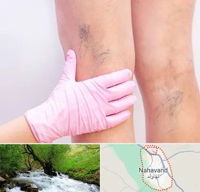 دکتر فوق تخصص واریس در نهاوند