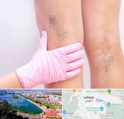 دکتر فوق تخصص واریس در لاهیجان