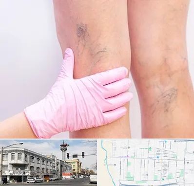 دکتر فوق تخصص واریس در 17شهریور