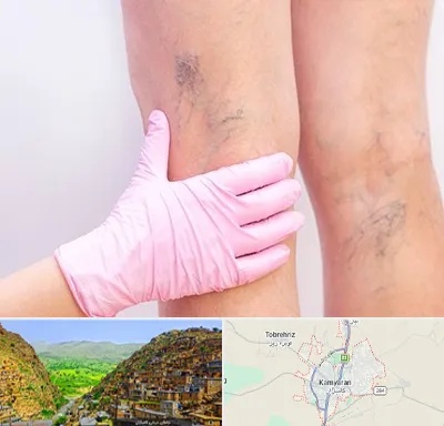 دکتر فوق تخصص واریس در کامیاران