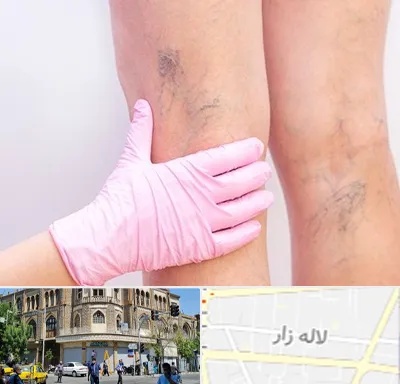 دکتر فوق تخصص واریس در لاله زار