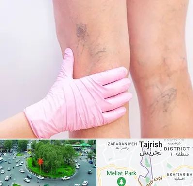 دکتر فوق تخصص واریس در تجریش 