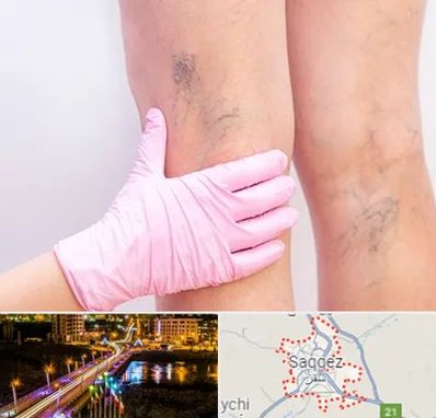 دکتر فوق تخصص واریس در سقز