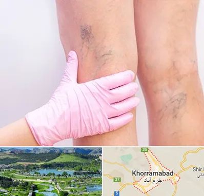 دکتر فوق تخصص واریس در خرم آباد