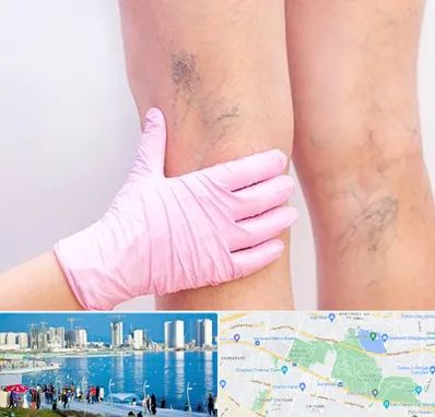 دکتر فوق تخصص واریس در چیتگر 