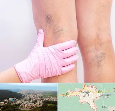 دکتر فوق تخصص واریس در گرگان