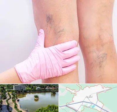 دکتر فوق تخصص واریس در لنگرود