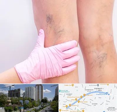 دکتر فوق تخصص واریس در اندرزگو 