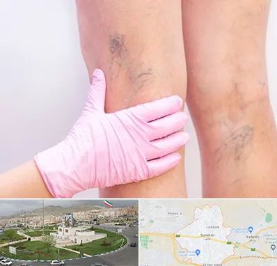 دکتر فوق تخصص واریس در بومهن