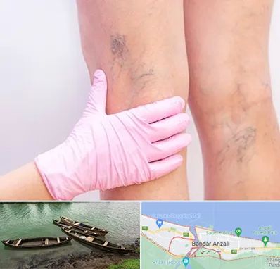 دکتر فوق تخصص واریس در بندر انزلی