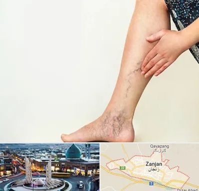 دکتر واریس در زنجان