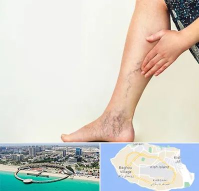 دکتر واریس در کیش