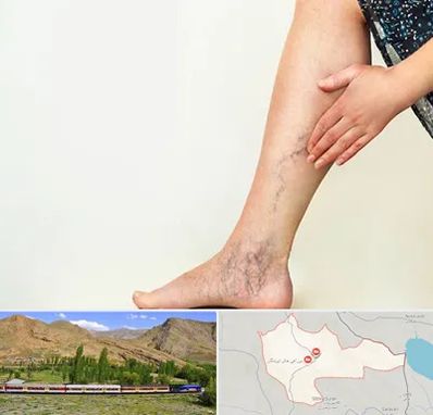 دکتر واریس در خاش